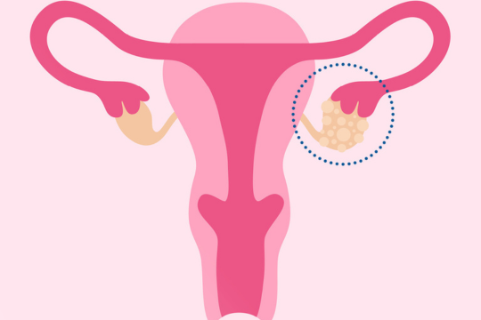 Ovarian-Cyst-treatment-in-pune
